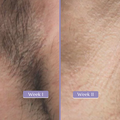 Serenity IPL Hair Removal Handset