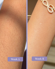 Laser hair removal machine in Pakistan that reduces hair growth and prevents hair growth permanently.