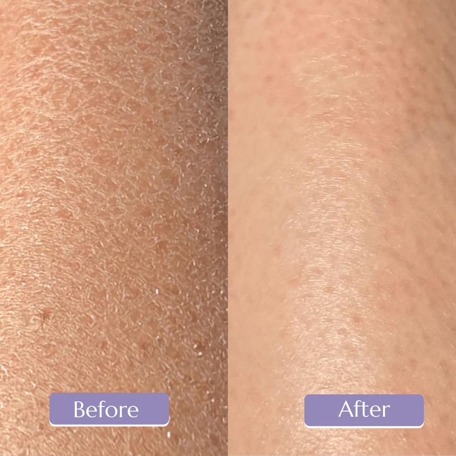 Before and after comparison of skin after using Setosa Skin Exfoliating glove with real results