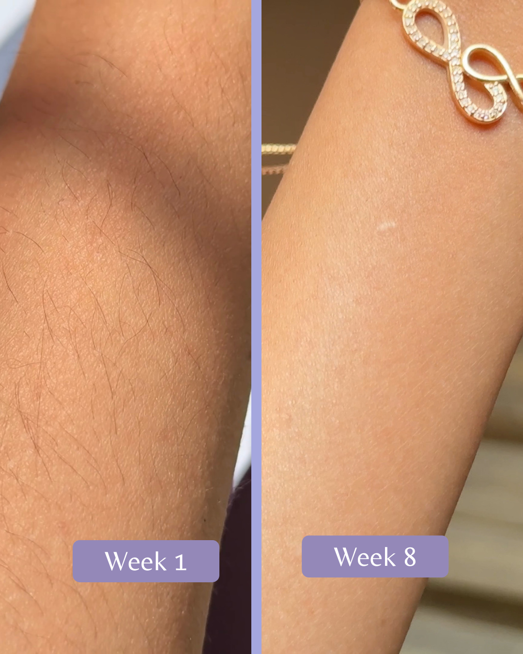 Laser hair removal machine in Pakistan that reduces hair growth and prevents hair growth permanently. 